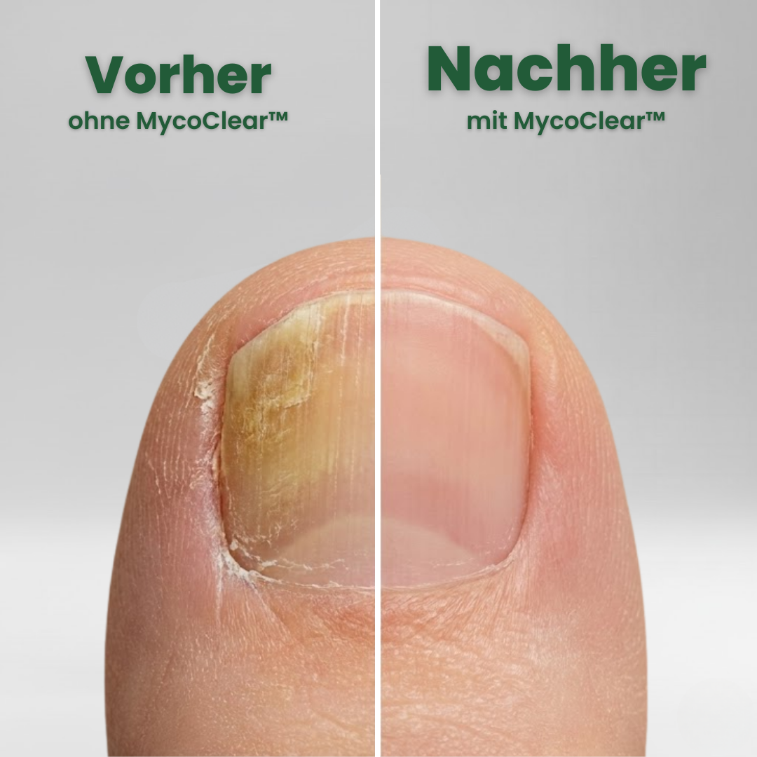 MycoClear™ - Patches für schönere Fussnägel
