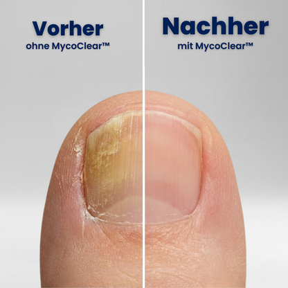 MycoClear™ - die Patches für schönere Fussnägel